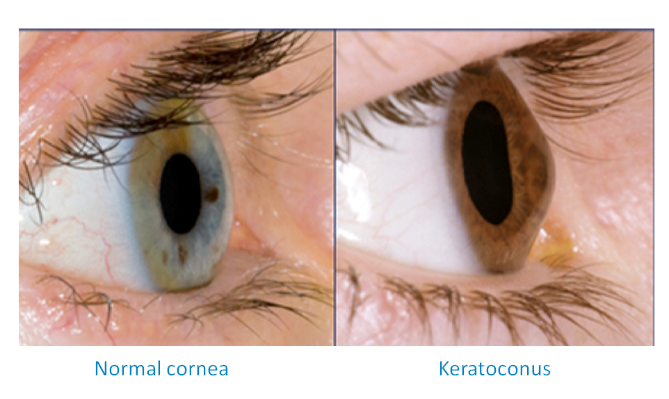 pellucid marginal degeneration ectasia