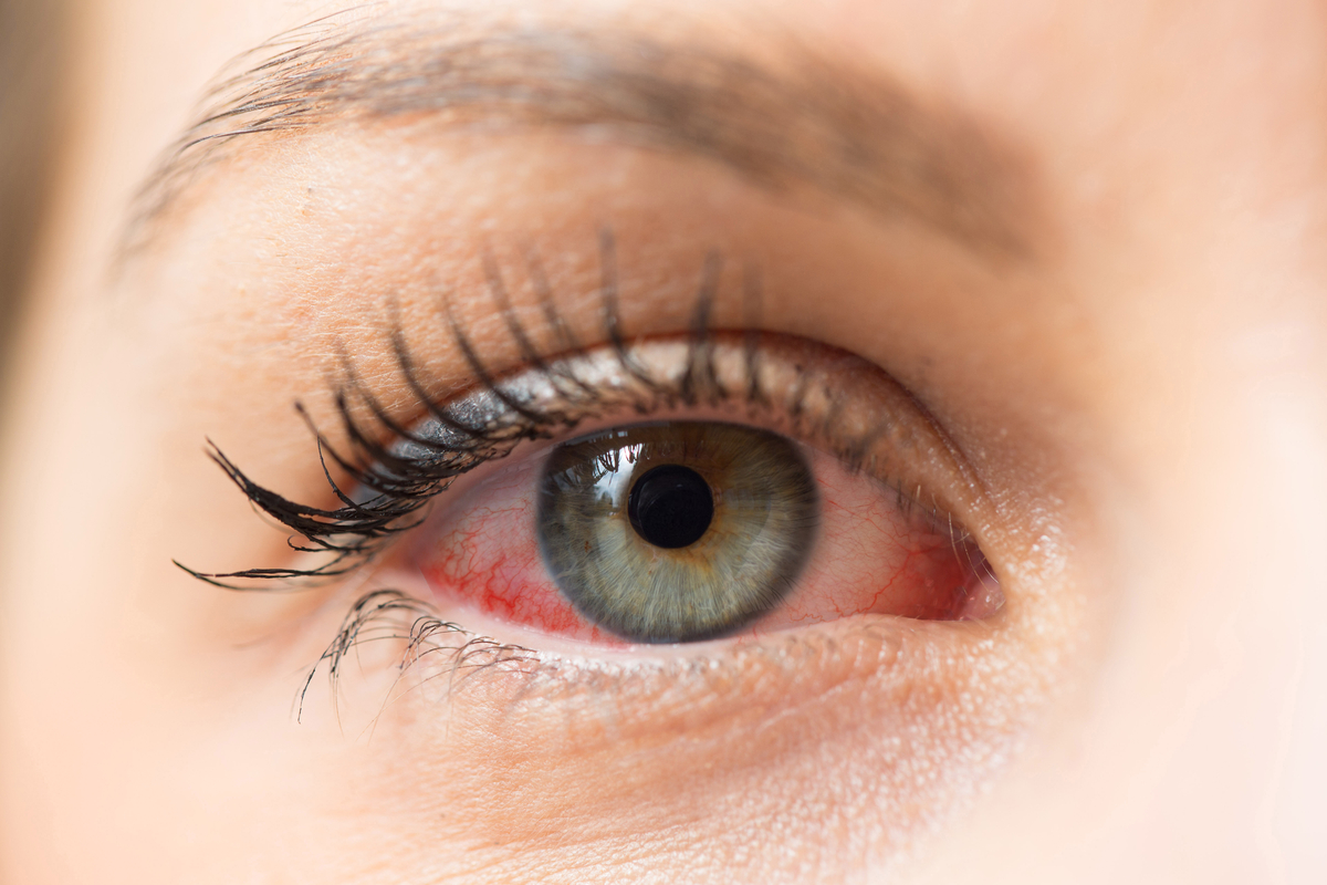alergijska reakcija na oku