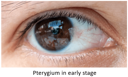 pterygium belgrade sveti vid