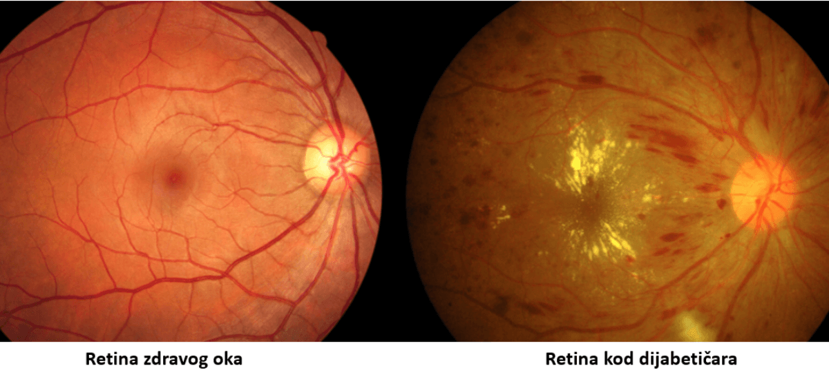 dijabetes u oftalmologiji