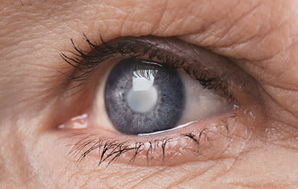 7 stvari o katarakti sveti vid