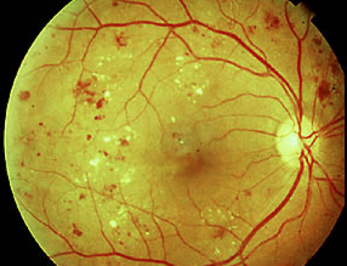 Šta je dijabetična retinopatija?