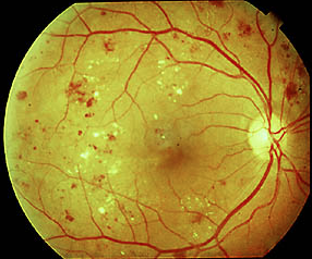 dijabetična retinopatija