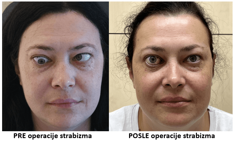pre i posle operacije strabizma