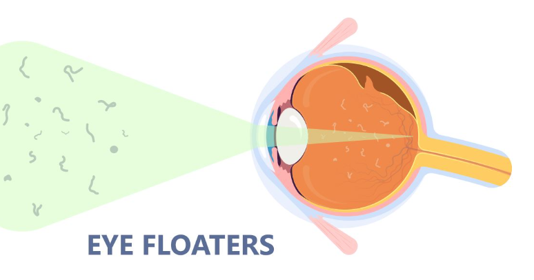 floatersi ili mušice u vidnom polju