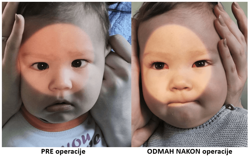 pre i posle uspešne operacije strabizma kod beba