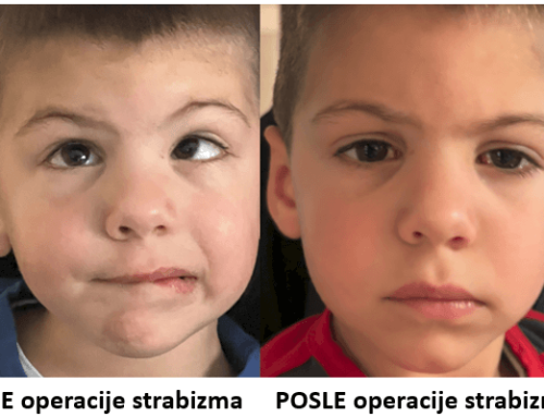Strabizam i operacija strabizma