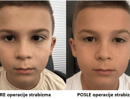 Značaj rane operacije strabizma