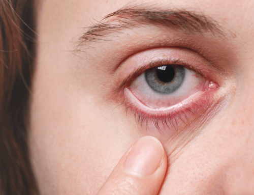 Kako prepoznati i kako se leči uveitis?